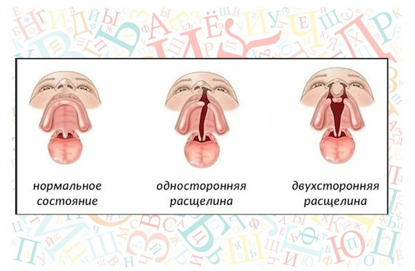 Ринолалия расщелина